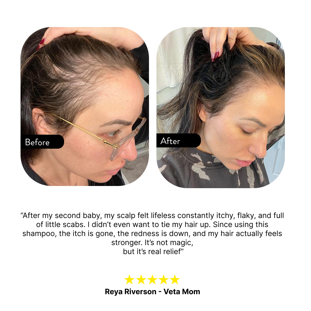 Anti-Shedding & Scalp Repair Postpartum Shampoo